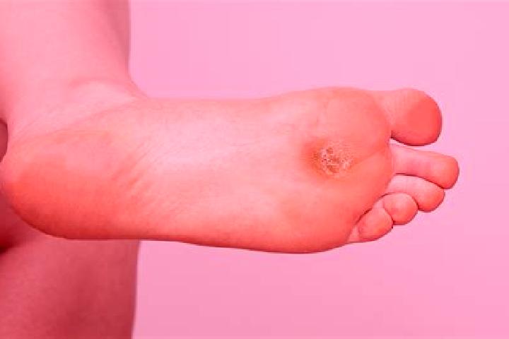 escort Callus